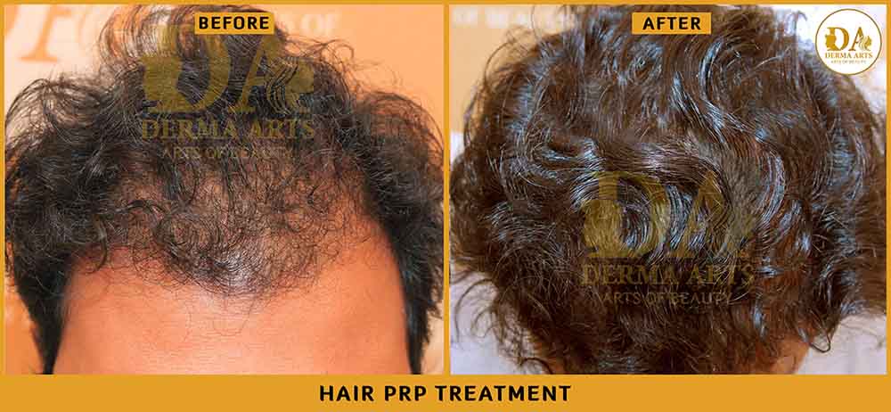 Delhi Hair PRP results